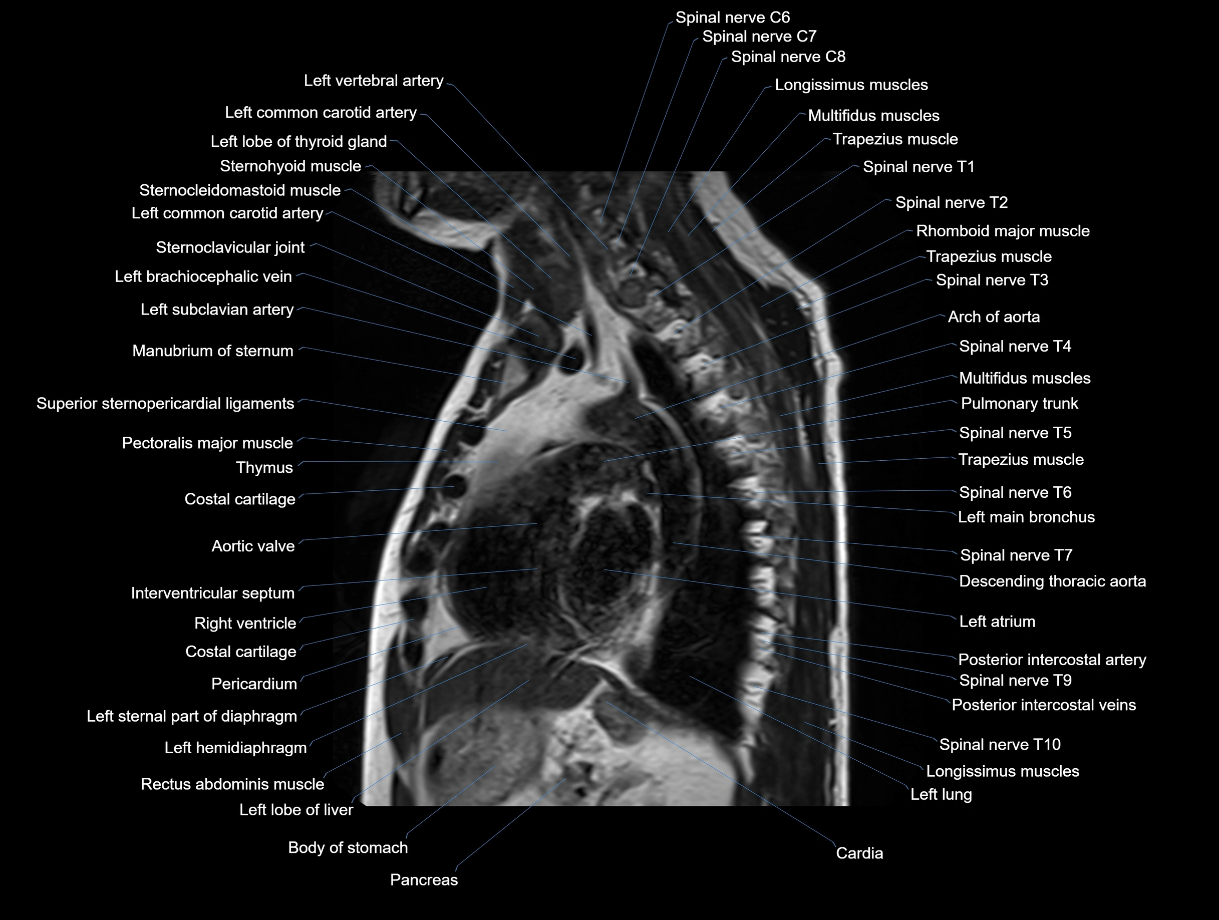 MRI chest (thorax) coronal  cross sectional anatomy 3T radiology  image-img-00001-00022.webp